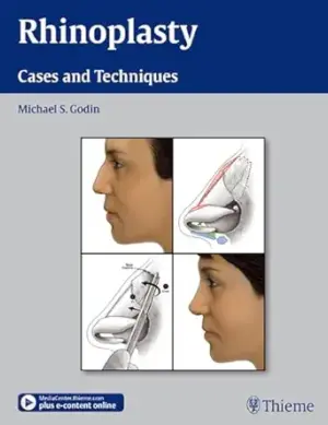 Rhinoplasty: Cases and Techniques