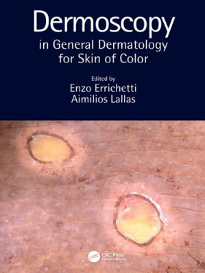 Dermoscopy in general dermatology for skin of colour